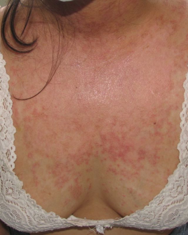 manifestaciones cutaneas lupus