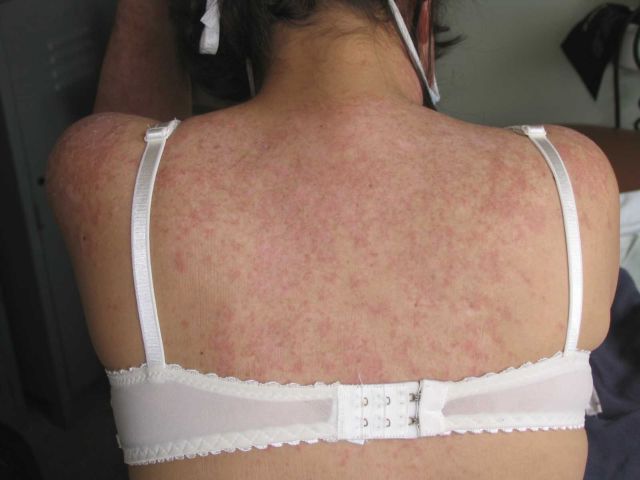 manifestaciones cutaneas lupus