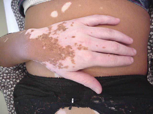 vitiligo