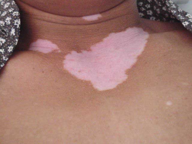vitiligo