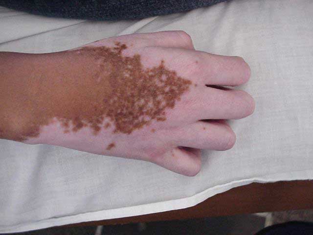 vitiligo